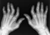 El parmaklarında bileklerde ağrı ve şişlik şikayetleriniz oluyorsa Romatoid Artrit (ilti...